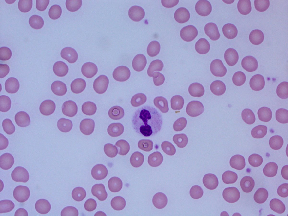 Peripheral blood showing macrocytic anemia and dysplastic granulocytes